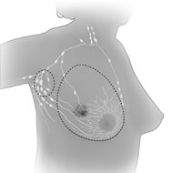 drawing of total mastectomy breast surgery